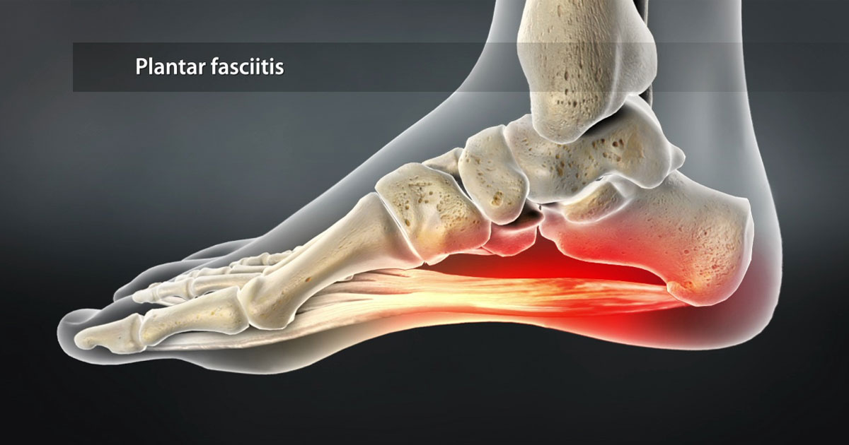 Plantar fasciitis is a condition that causes pain in the heel and bottom of the foot. Learn how physiotherapy can help with this condition.